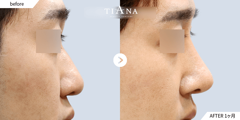 鼻筋と鼻先の高さを同時に調整|横顔 術後1ヶ月 韓国 鼻整形 ビフォーアフター ティアナ
