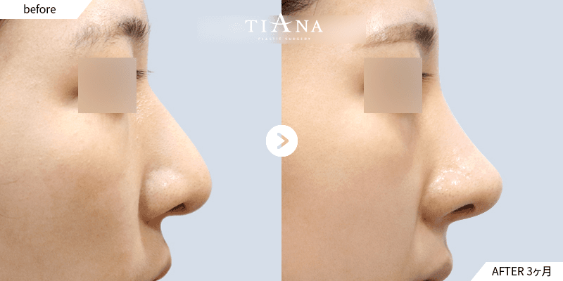 鼻全体のバランスを調整 韓国 鼻整形 ビフォーアフター ティアナ