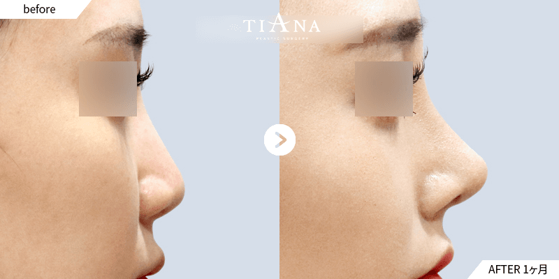 低い鼻筋を高く、自然な横顔に|術後1ヶ月 韓国 鼻整形 ビフォーアフター ティアナ