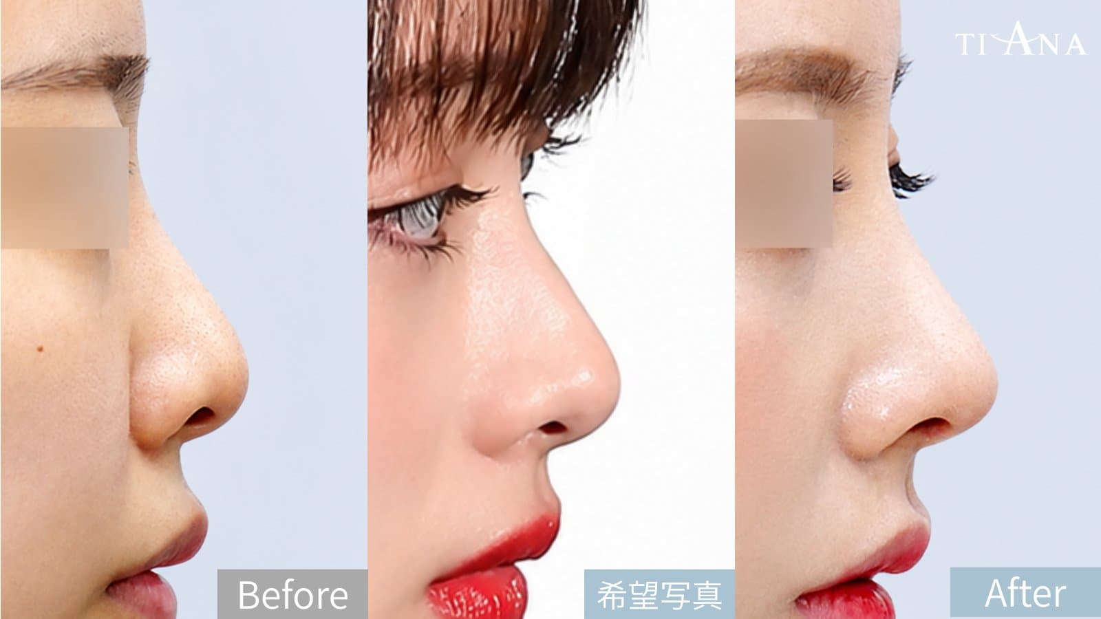 韓国 鼻整形 ビフォーアフター Before 希望写真 After ティアナ