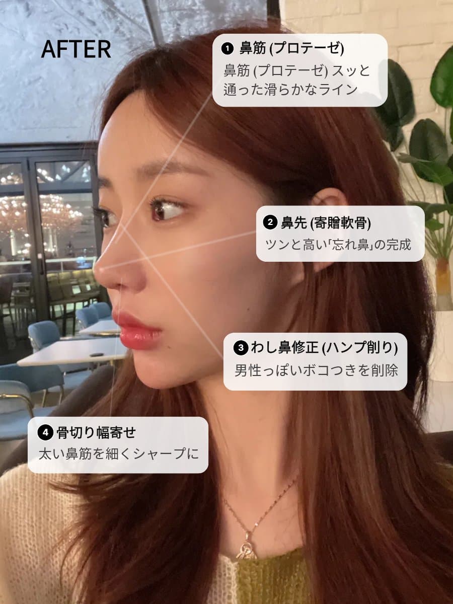 韓国 鼻整形 施術ポイント解説 鼻筋プロテーゼ・鼻先・ハンプ削り・骨切り ティアナ