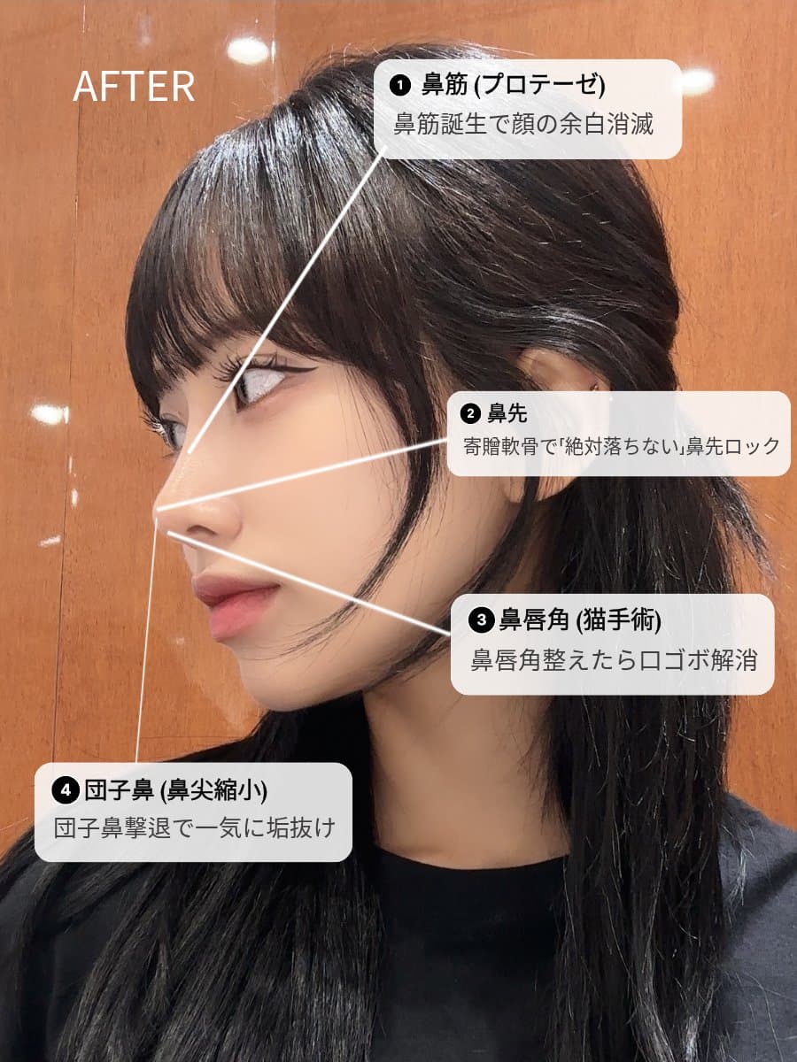 韓国鼻整形 団子鼻 鼻尖縮小 鼻唇角 自然な仕上がり ティアナ